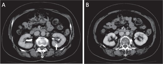 Images of enhanced CT scan. Enhanced CT revealed a 15-mm diameter tumor in the pelvis of the left kidney (A) and swelling of the regional lymph nodes, which showed a low-density area (B).