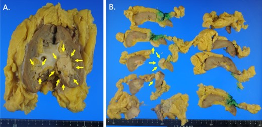 Macroscopic photographs of the tumor. Macroscopic photographs of the coronal section (A) and horizontal section (B) of the kidney. Arrows indicate the tumor.