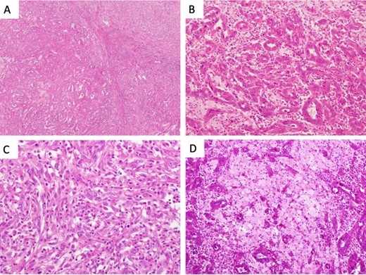 Microscopical photographs of the tumor. Microscopical photographs of the tumor stained by hematoxylin and eosin staining. Original magnifications of the objective lens of A, B, C and D are ×4, ×20, ×20 and ×20, respectively.