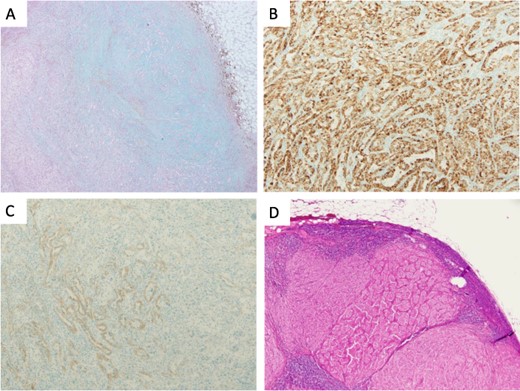 Microscopical photographs of the tumor stained by alcian blue staining and immunohistochemistry of the tumor and the metastatic lesion of the lymph node. The microscopical photographs of tumor with alcian blue staining (A), immunohistochemical staining of AMACR (B) and E-cadherin (C) are shown. A microscopical photograph of lymph node-metastasis of the tumor is also shown (D). Original magnification of the objective lens of A, B, C and D is ×10, ×10, ×10 and ×4, respectively.