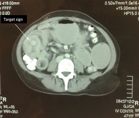 Axial CT image of abdomen; target sign.