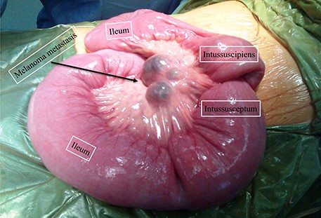 Findings at laparotomy demonstrating multiple pigmented lesions with ileoileal intussusception.
