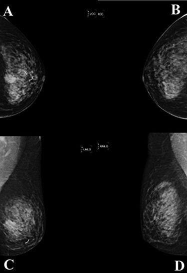 A mammogram of the breasts revealed a mass with angular and ill-defined boarder at palpable area in left mid breast size 23 × 19 mm. (A; left cranial caudal view, C; left mediolateral—oblique view), comparison with the right breast (B; right cranial caudal view, D; right mediolateral—oblique view).