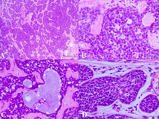 (A) Histologic examination showed the neoplastic cells predominantly arranged in a solid growth pattern (100×). (B) The true glandular spaces lined by luminal-type epithelial cells (600×). (C) The pseudolumens containing watery basophilic mucopolysaccharides basement membrane-like materials rimmed myoepithelial cells (400×). (D) Intraductal components composed of a dual population as the invasive areas (600×)