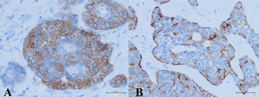 Immunohistochemistry study revealed two different cell populations. The cells surrounding true glandular lumens decorated by CK7 and CD117 (A), while CK5/6 and p63 were positive in myoepithelial cells (B).
