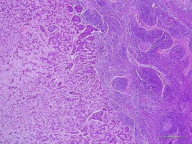 Histologic examination demonstrated metastatic ACC to axillary lymph node (40×).