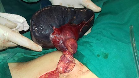 Infarcted spleen free of any ligamentous attachments and the twisted vessels.