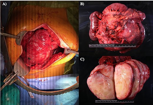 (A) Midline laparotomy with in situ specimen. (B) En bloc resected specimen, consisting of two anastomosing segments of small bowel, as well as a 15.0 × 14.2 × 2.5 cm round mass. (C) Sectioned mass revealing a tan-white, encapsulated gelatinous interior without evidence of necrosis or hemorrhage.