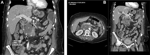 (A, B) CT scan preoperatively.