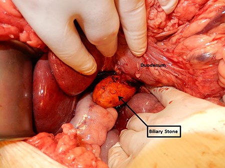 Intraoperative situs.