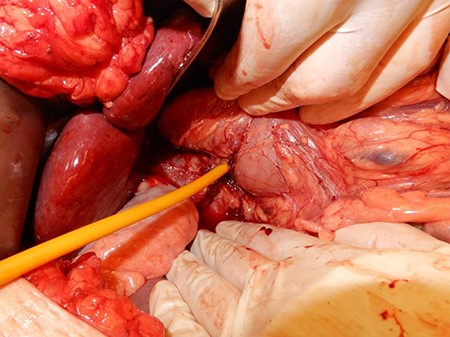 Duodenum after stone removal and placed T-drain.