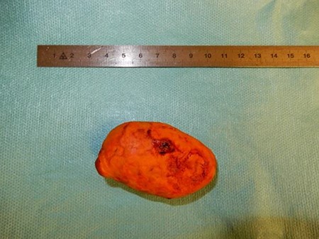 Biliary stone.