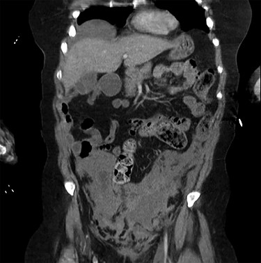 Coronal view of the CT scan showing the localized pelvic haematoma.