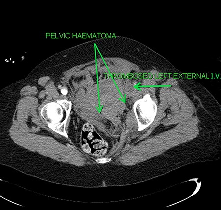 Axial sections of the CT scan showing the thrombosed external iliac vein (I.V.) and the pelvic haematoma.