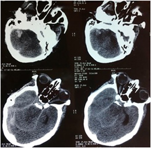 CT scan, axial sections, showing a FISHER IV subarachnoid hemorrhage with a right cerebellum hematoma.
