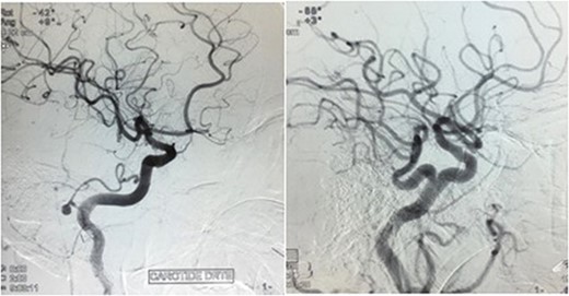Angiography showing medious saccular aneurysm (4.8 × 4.6 mm) taking origin from a PMA with the persistence of a left trigeminal artery.