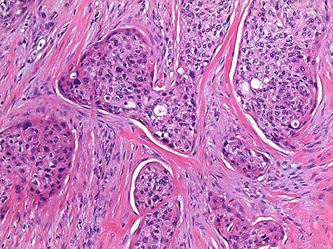 moderately to poorly differentiated squamous cell cancer.