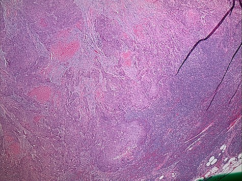 lymph node involvement.