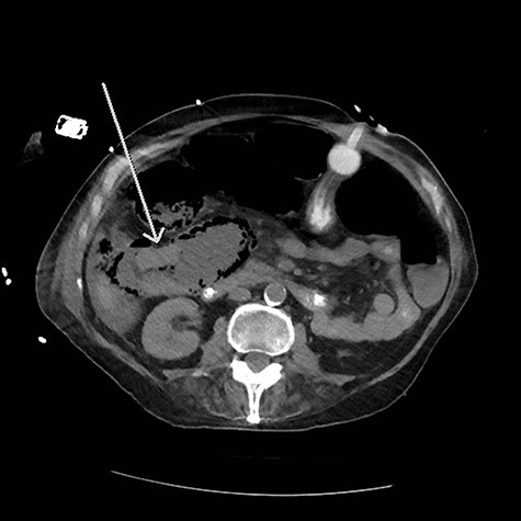 ascending colon mass.