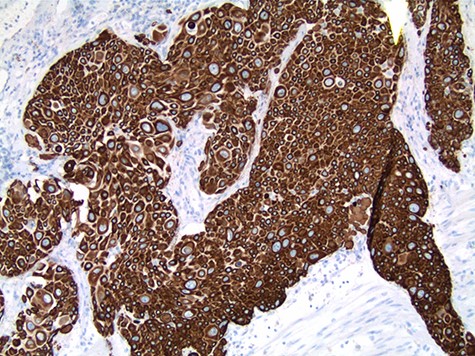 CK 5/6 histochemistry is diffusely positive.