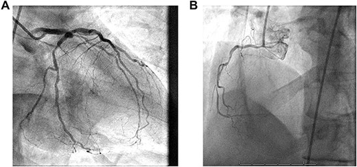 (A) 1. Left main coronary artery: large caliber vessel with distal 60% stenosis. 2. Left anterior descending coronary artery (LAD): large caliber vessel with proximal 80% stenosis gives rise to diagonals and septals. 3. Left circumflex coronary artery: large caliber, nondominant gives rise to OM 1 with proximal 70% stenosis before continuing with mid LCx 75% stenosis and distal 40% lesion. (B) Right coronary artery (RCA): medium caliber vessel that is dominant with proximal 85%, mid 85% and distal occlusion prior to PDA fills with left to right collaterals.