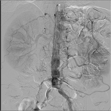 Mesenteric angiogram: both the celiac and superior mesenteric arteries are totally occluded, and the IMA provides the meandering mesenteric collateral. There was a 90% stenosis at the orifice of the IMA.