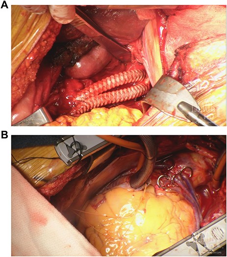 (A) Supra-celiac aorto-celiac and aorto-superior mesenteric bypass using a bifurcated Dacron graft. (B) CABG ×5 with proximal SVG anastomoses to the ascending aorta for D1, OM1, OM2 and PDA grafts. LIMA to mid-LAD graft not seen in this image.