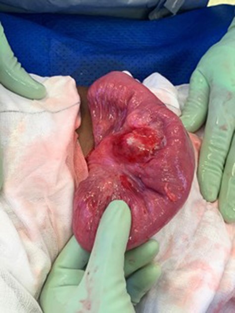 Intraoperative finding of an inflammatory mass in the mesentery of jejunum with necrotic centre.