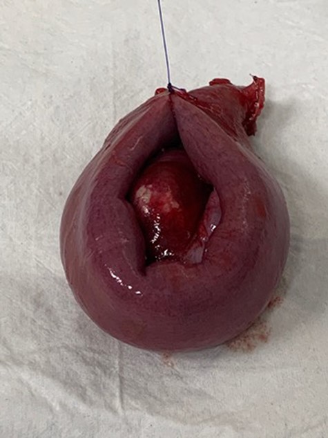 Segmental resection of jejunum was performed.