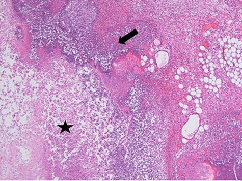 Necrosis (star) and acute inflammation with the presence of stromal neutrophils (arrow) within the mesenteric mass (H&E stain, x100).
