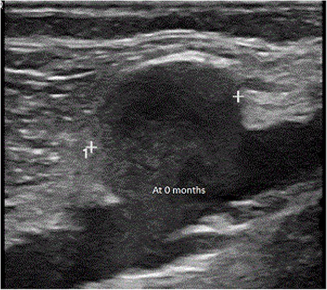 Aneurysm at diagnosis.