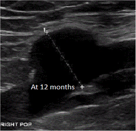 Aneurysm at 12 months.