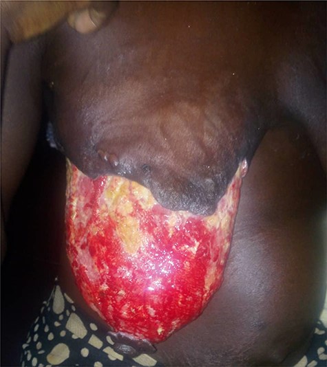 Post debridement.