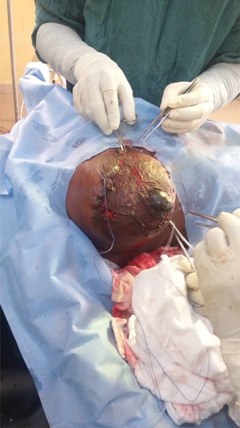 Intraoperative skin graft application.