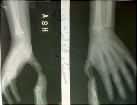 X-ray imaging of the right hand showed small-sized bones of the right thumb including first metacarpal and phalanges, it also showed the good alignment of the CMC and MCP joints.