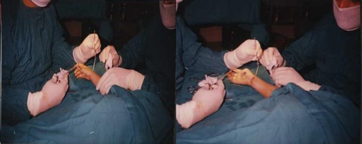 During the surgery.