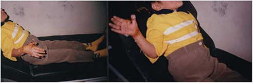 Two weeks after the surgery, after removing the stitches.