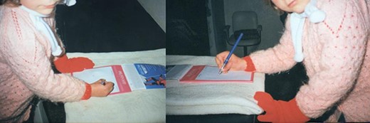 Six months after the surgery, she was able to hold a pen and write with good flexion and extension of the thumb.