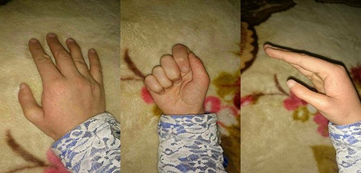 Seventeen years after the surgery (in 2018). The smallness of the thumb was observed, the extension and abduction of the thumb had a good range of motion with a sufficient pinch grip and were sufficient for her to become a university student.