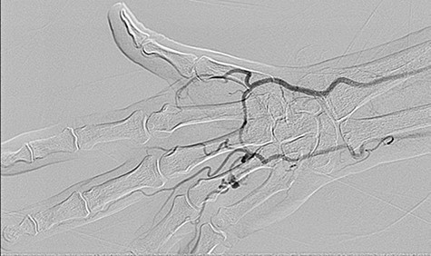 Angiogram showing aneurysm of the common palmar digital artery in the fourth web space.
