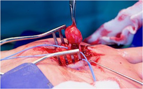 Intraoperative view of the aneurysm.
