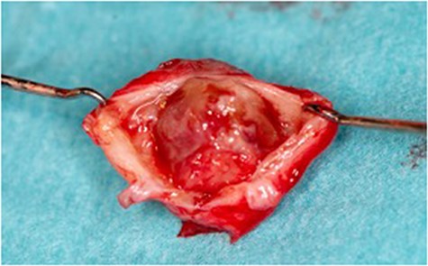 Divided aneurysmal sac.