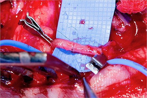 Repair of the common palmar digital artery.
