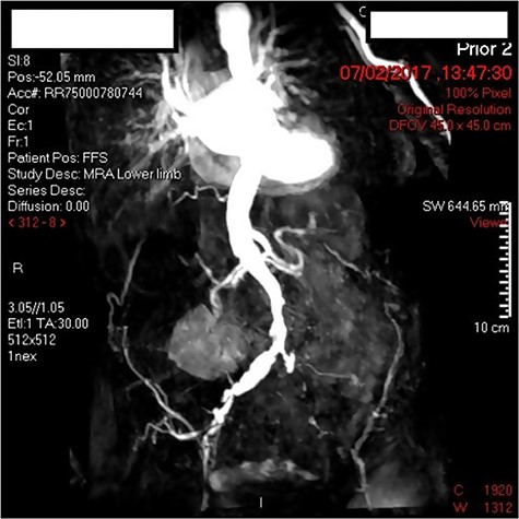 MRA of aortoiliac segment.