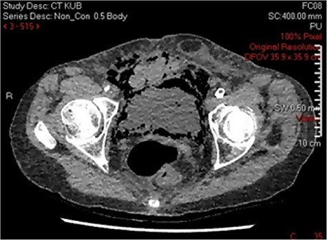 CT KUB demonstrating EC.