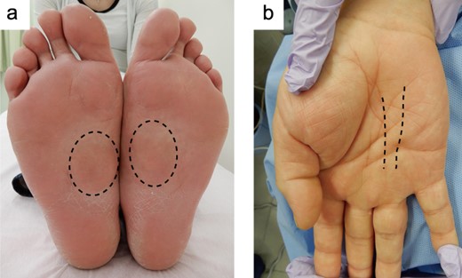 Gross appearance of the bilateral plantar (a) and the right palmar (b). Dot circles and lines indicate the mass or the thick chord.