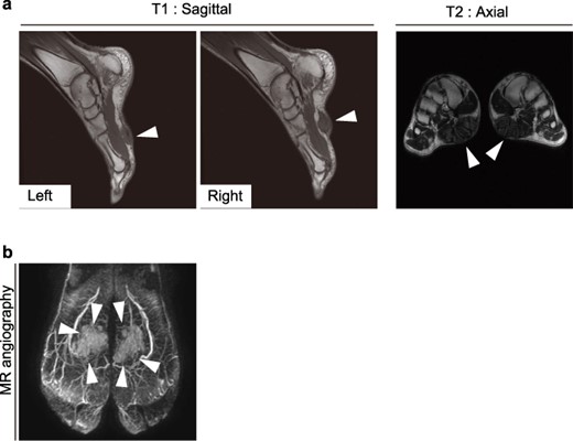 MRI (a) and MR angiographic imaging of the foot (b). White arrowheads indicate the mass.