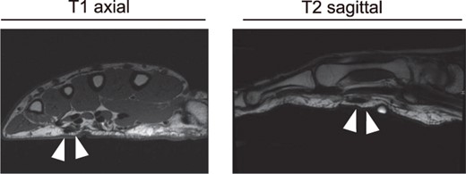 MRI images of the right palmar. White arrowheads indicate the chord.