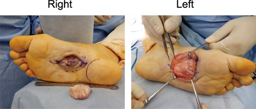 Intraoperative findings.