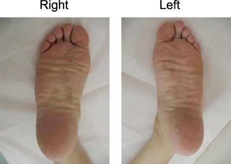 Postoperative findings 6 months after the operation.